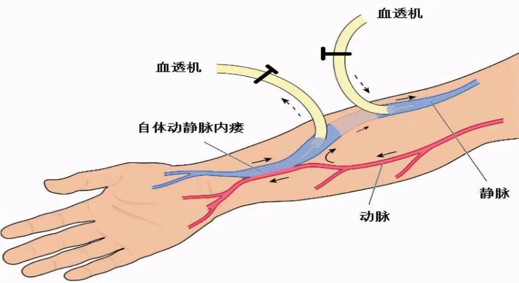 科普|血液透析患者日常內(nèi)瘺的維護(hù)妙招